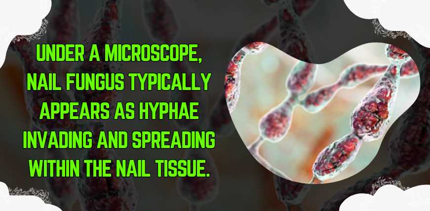 Under a microscope, nail fungus typically appears as hyphae invading and spreading within the nail tissue.