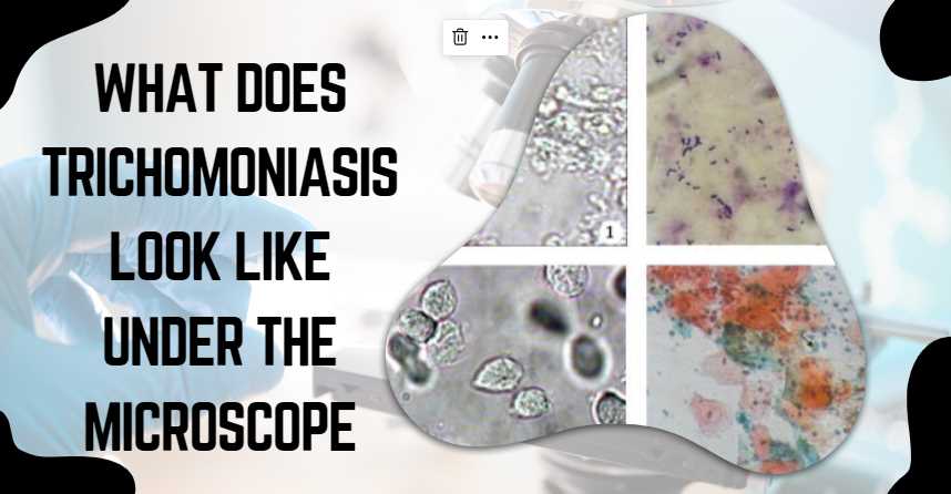What Does Trichomoniasis Look Like under the Microscope